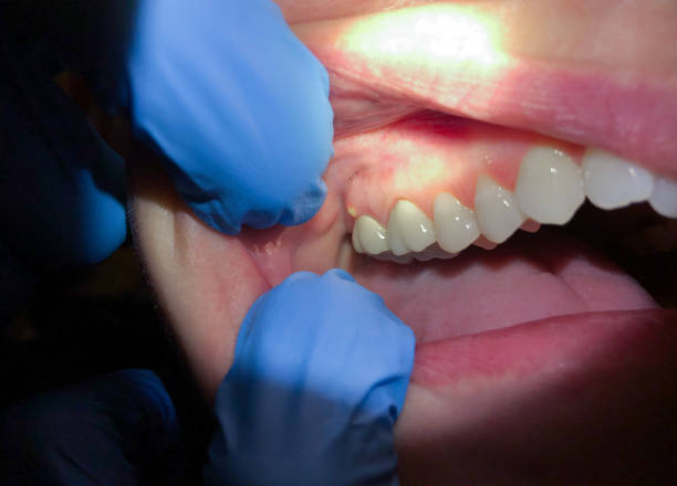 Best Emergency Tooth Extraction in Cuero, TX