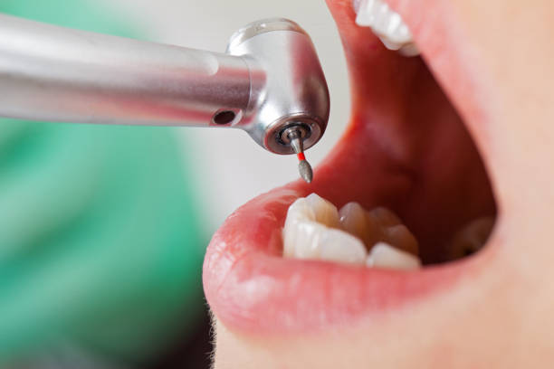 Best Emergency Tooth Extraction in Cuero, TX
